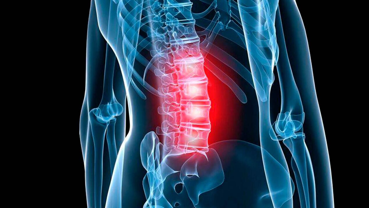 simptomi lumbalne osteohondroze