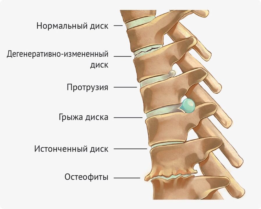 Deformacije diska za lumbalnu osteohondrozu