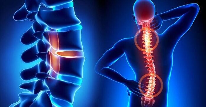 lokalizacija boli u osteohondrozi