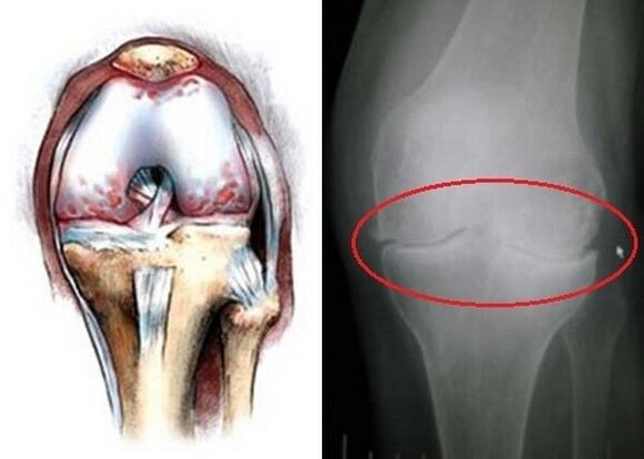 osteoartritis zgloba koljena